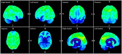 Major depression associated with a levonorgestrel-releasing intrauterine system mimicking frontotemporal dementia: a case report